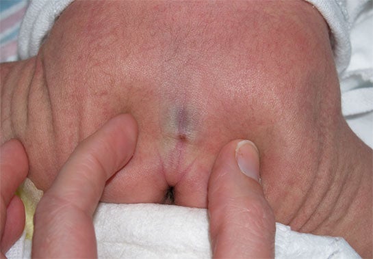 sacral dimple2.jpg